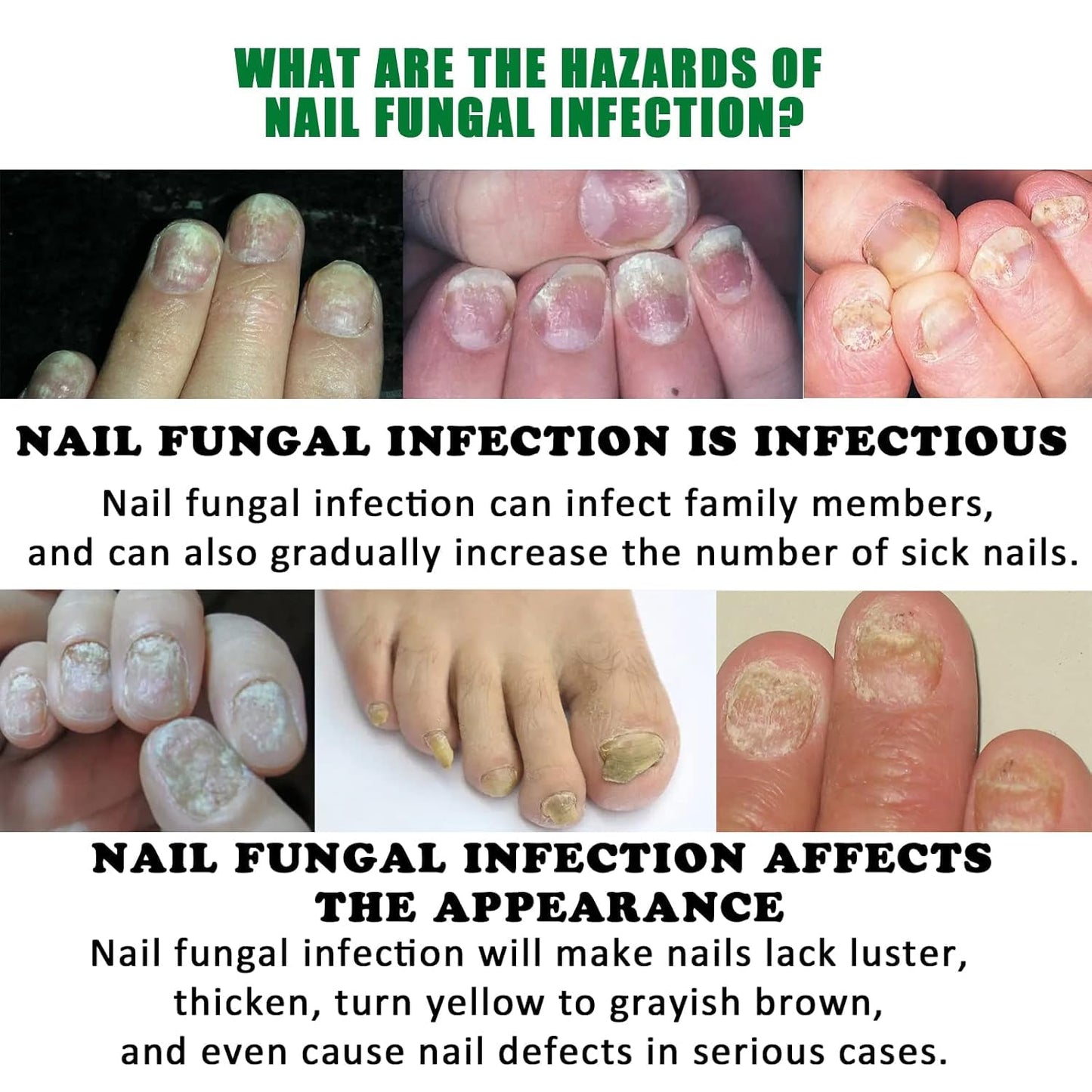 Esmalte Mágico Anti-hongos